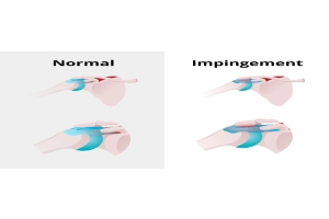 Impingement